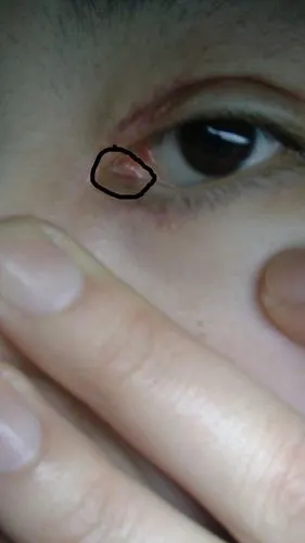 我左眼内眼角长了个小红包,有点痒,开内