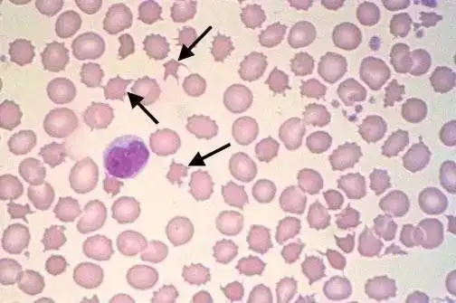 棘形红细胞,细胞突起较长而不规则,见于棘红细胞增多症(可达70%~80&)