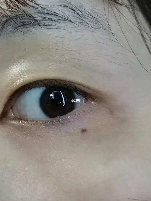 早上起来眼下突然多了颗痣