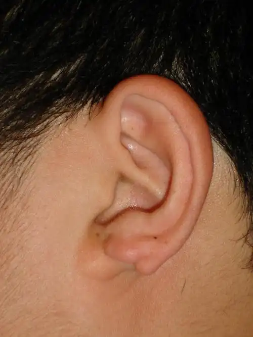 各式各样的耳廓畸形-耳垂裂_耳部整形_耳部整形症状 - 好大夫在线
