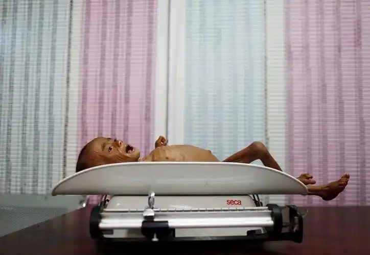 也门战事持续 儿童瘦成"皮包骨"