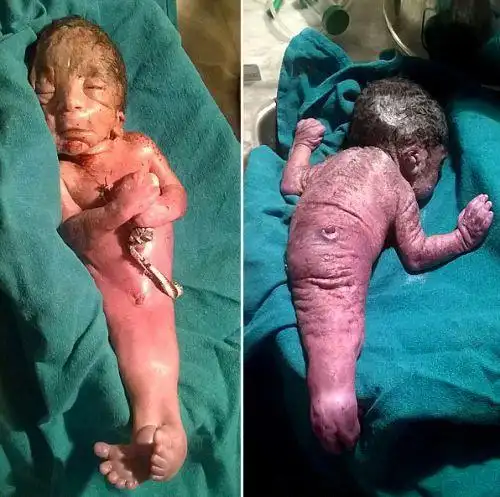 人文艺术 关注新闻 小美人鱼尸骨宝宝传说