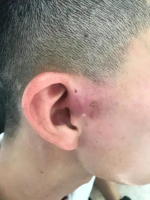 往往出生时即有,多数表现为耳轮脚前小孔(老百姓的话就是耳前小孔)