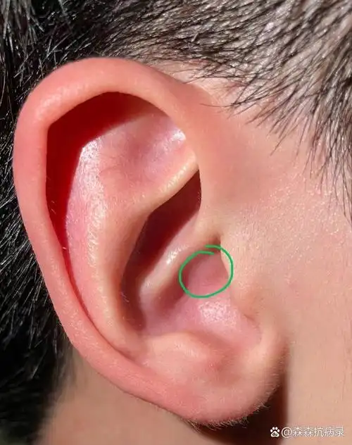 p>又红又痒的耳朵咋回事 br>小伙子耳朵又红又肿,还瘙痒难耐,6月份发