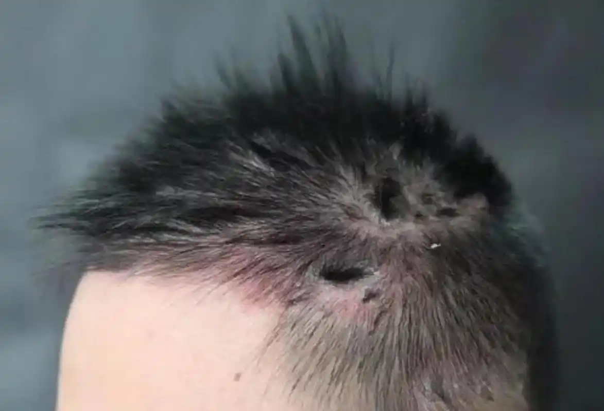 你的头上是不是在长癣?头皮屑"满天飞"吗?头上发红,发痒吗?