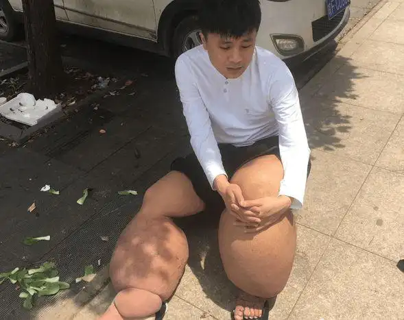 辽宁帅小伙患绝症拖200斤大象腿四处乞讨