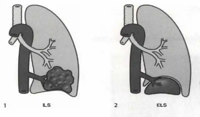 肺隔离症你了解吗?