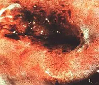 女人远离宫颈癌有3个信号一定要牢牢记住