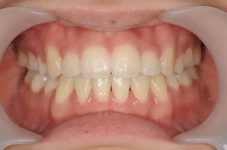 标准的牙齿咬合到底是什么样的? - 知乎