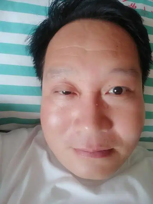 眼睑下垂治疗的漫长之路 - 美篇