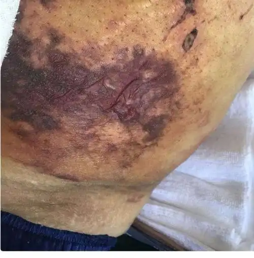 经人介绍去了富河国际一楼星傲医疗美容门诊做了抽脂手术,手术后伤口