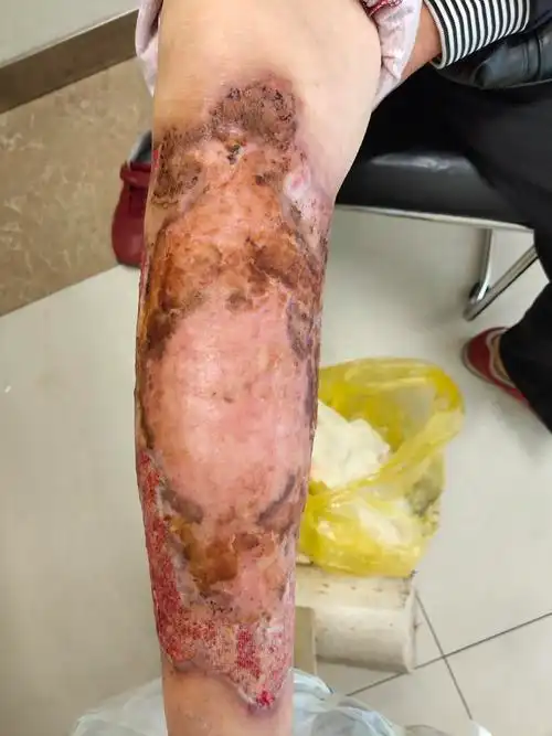 11.14陆瑞红右下肢皮肤溃疡第一次门诊换药记 - 美篇