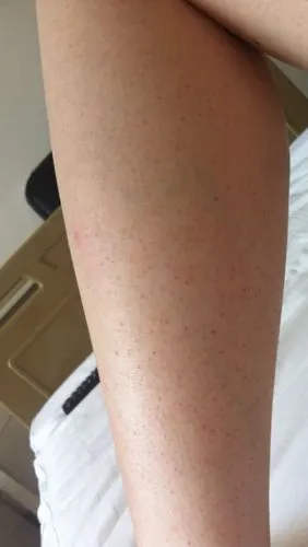 小腿肚上有红点,很明显,好像是毛囊堵塞,在网上买好多抹的都不好使