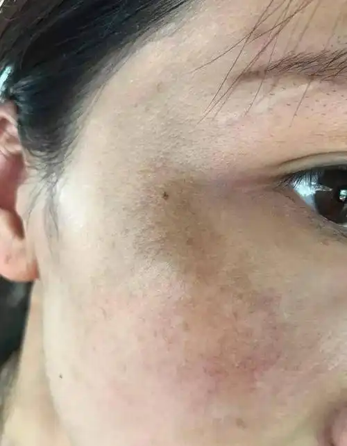 肝炎患者也长黄褐斑,别担心,试试2个淡斑处方!