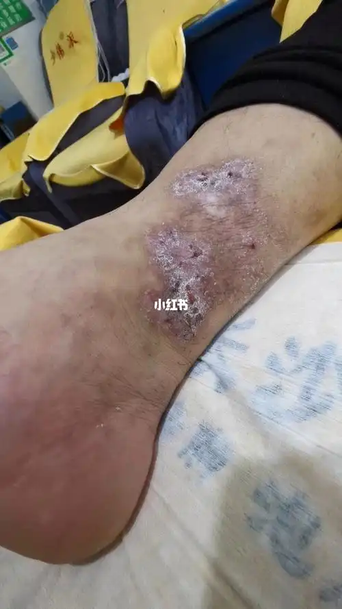 湿疹皮炎反复瘙痒