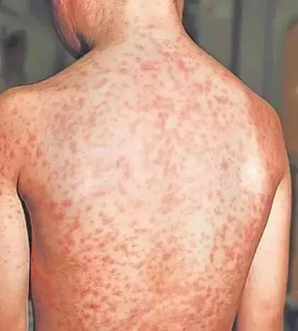 多国爆发麻疹疫情,目前尚无特效药…家长及时做好预防!