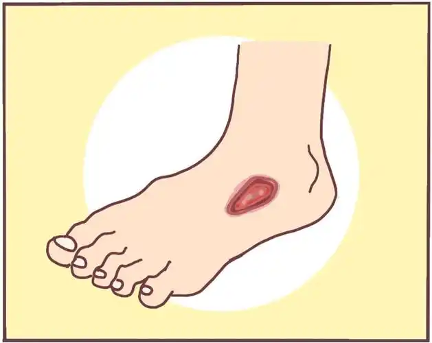 症状三:伤口不易愈合糖尿病容易发生各种细菌,真菌感染,加上血糖过高