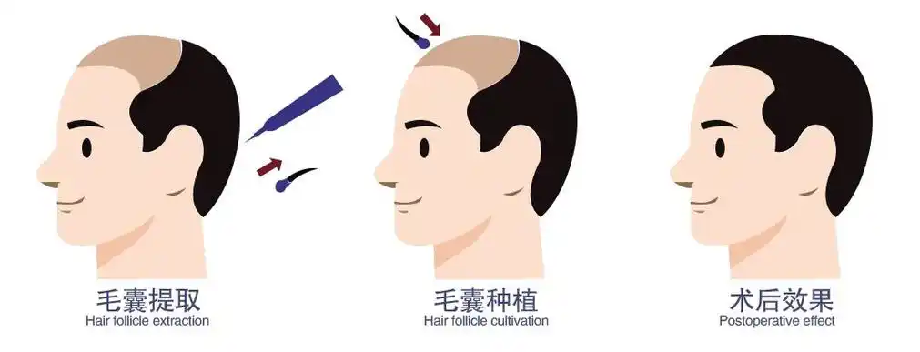 年纪轻轻就脱发秃顶怎么办全省招募毛发缺失者可申请免费植发脱发秃顶