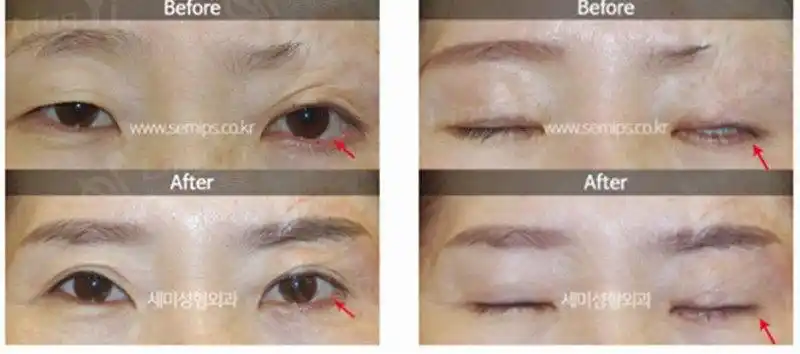 世美下眼睑外翻前后对比照