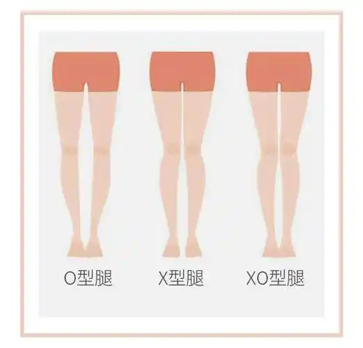 我们的腿型一般分为正常,内八(膝内翻,即o形腿,俗称罗圈腿),外八