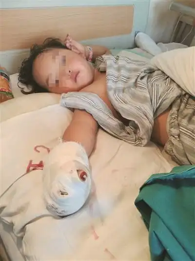 右手被绞肉机"吞食"后,2岁半的晓琳4根手指被截肢. 晓琳父亲供图