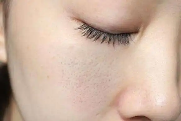 怎样缩小脸上的毛孔粗大图15