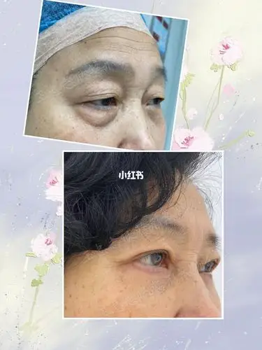 老年双眼皮,眼袋整复术后一周