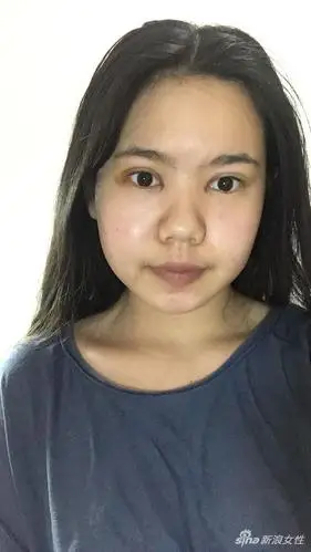 害怕双眼皮手术的恢复期真人秀教你如何跳过它