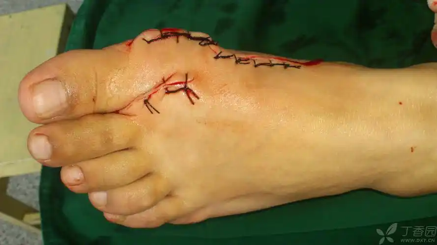 拇外翻第一跖骨截骨矫形