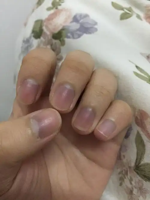 我一到冬天手脚发冷,指甲还发紫怎么办?