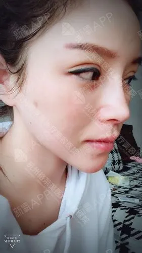 zz_自体脂肪全脸填充第15天美丽日记