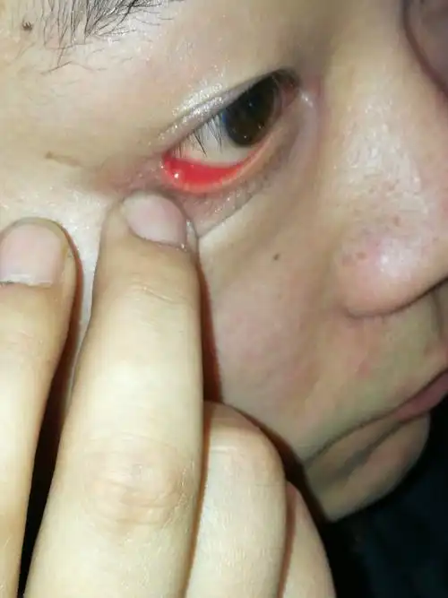 眼睛眨眼就疼有个疙瘩,这是什么会自己好吗