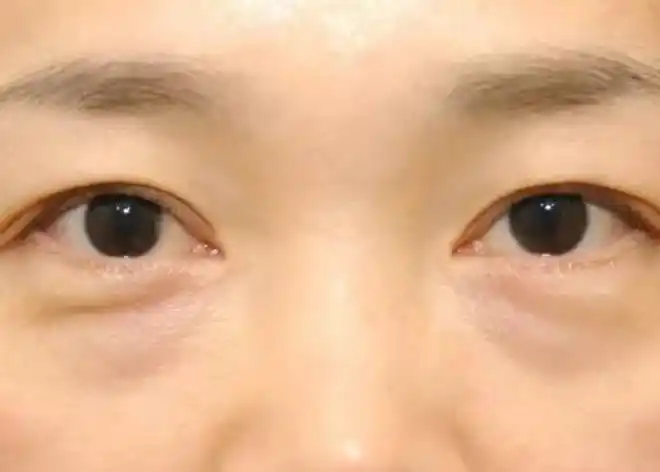 醒来时眼睑浮肿是眼睛感染了还是正常现象