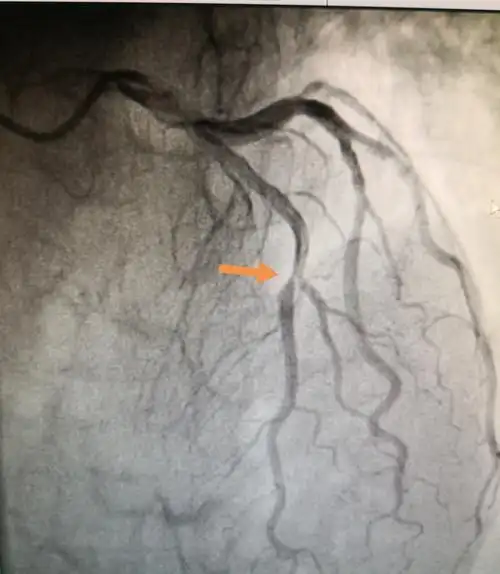查"缺"补漏,让心更完美-先心病治疗应尽早