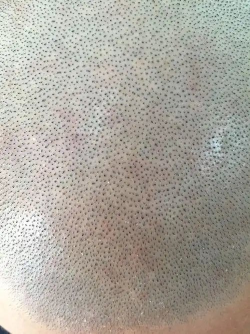 这是什么情况?一直觉的头皮好痒,昨个剃了个光头,密密麻麻的红点