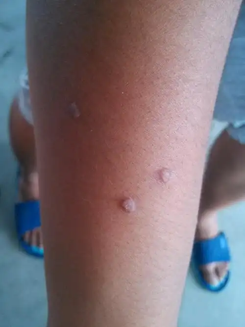 我胳膊上长了六个,像米粒大小的痘痘,不痛不痒,就