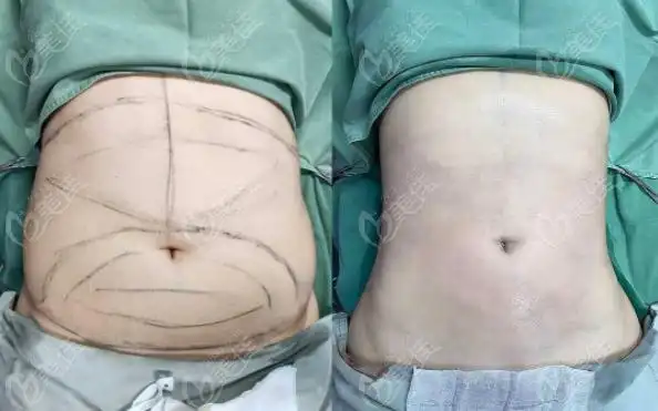 赵亚均腰腹环吸手术效果图