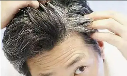 少年有白头发怎么办?
