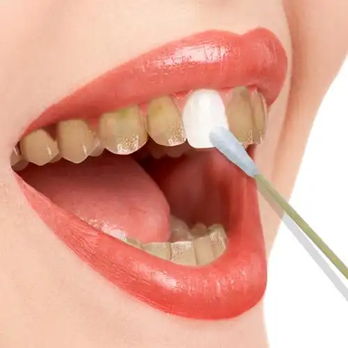 牙齿美白洗牙粉黄牙烟牙去牙垢牙斑烟渍牙结石洁牙素白牙素菌口臭_7折