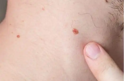 腹股沟长疣图片(颈部出现的神秘) - 赤虎壹号