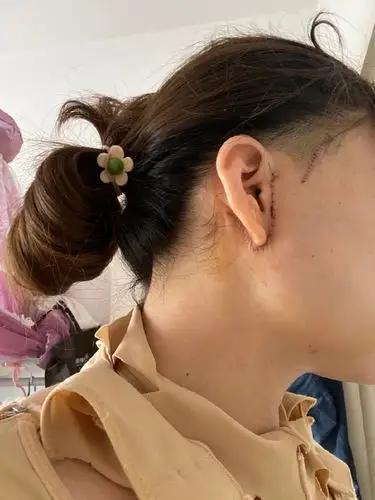 做完小拉皮,担心伤口愈合问题,现在觉得还算可以,恢_圈子-新氧美容