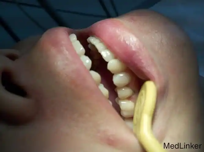 畸形中央尖引起根尖周炎1例