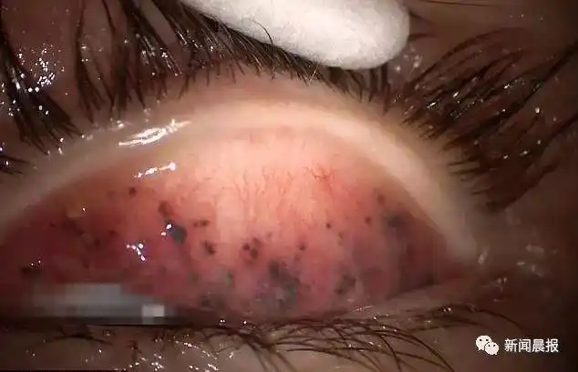 可怕!女子眼睛里长满密密麻麻的…每晚睡觉前可千万别忘这件事!