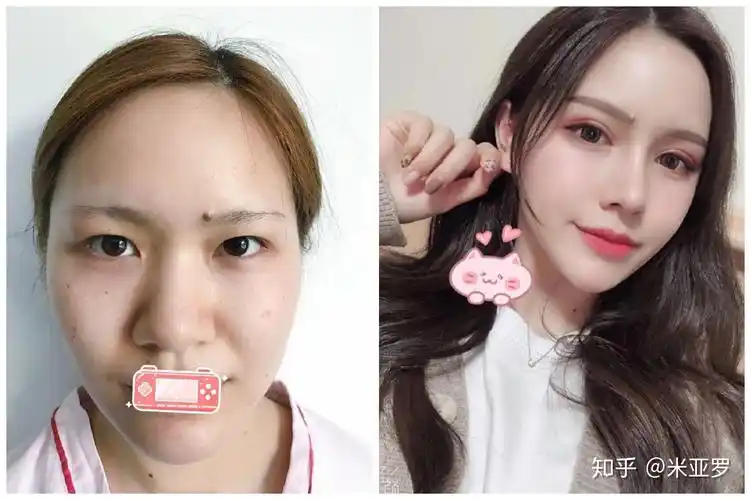 塌鼻子是大众脸,朝天鼻会拉低颜值,几种"丑鼻型"你中了吗?