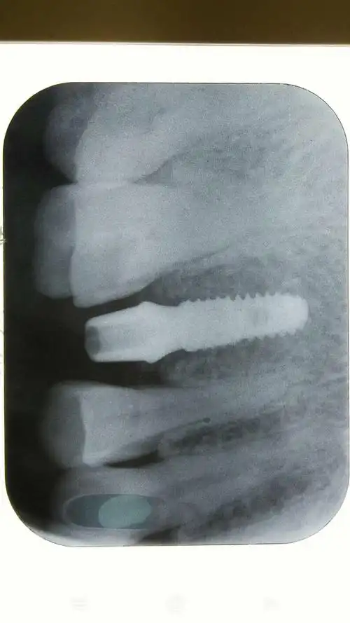 青年牙医胡医生种植牙病例分享