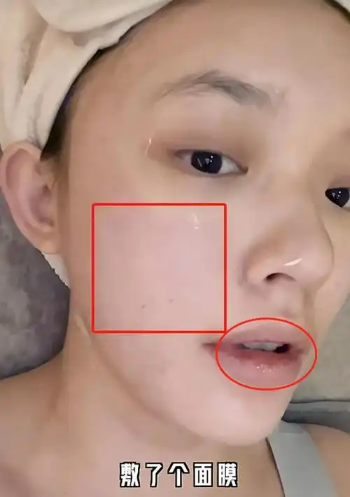 美的代价!"星女郎"林允晒打水光针视频,额头满是针眼渗血珠