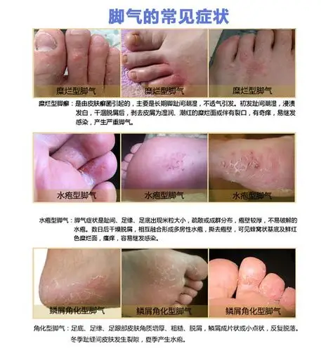 马油脚气膏去脚气止痒脱皮水泡糜烂脚汗脚臭神器泡脚药oem