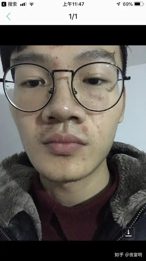 面部脂溢性皮炎特点(面部脂溢性皮炎的原因) - 123植物网