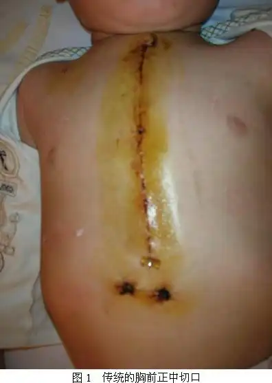 右开胸房间隔缺损直视修补术