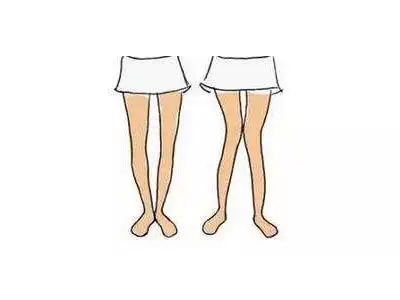 o型腿走路外八字步怎么矫正